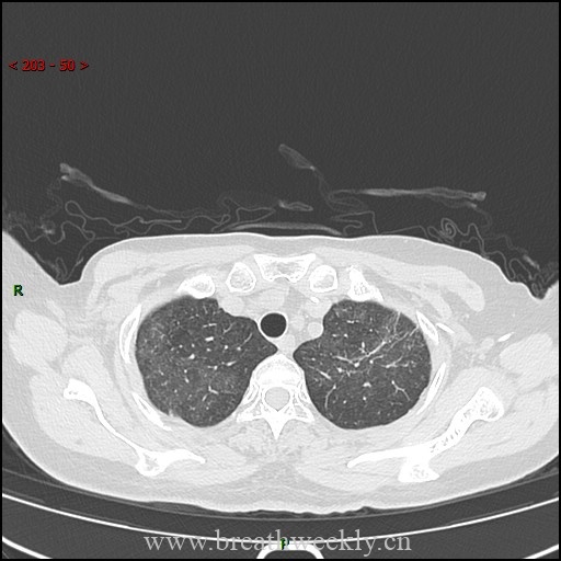 图片[3]-病例57 药物性肺损伤影像读片 | 每周呼吸-每周呼吸