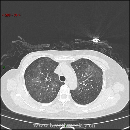 病例57 药物性肺损伤影像读片 | 每周呼吸-每周呼吸