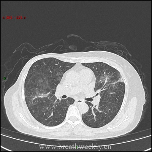 图片[9]-病例57 药物性肺损伤影像读片 | 每周呼吸-每周呼吸