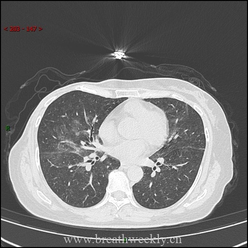 图片[11]-病例57 药物性肺损伤影像读片 | 每周呼吸-每周呼吸