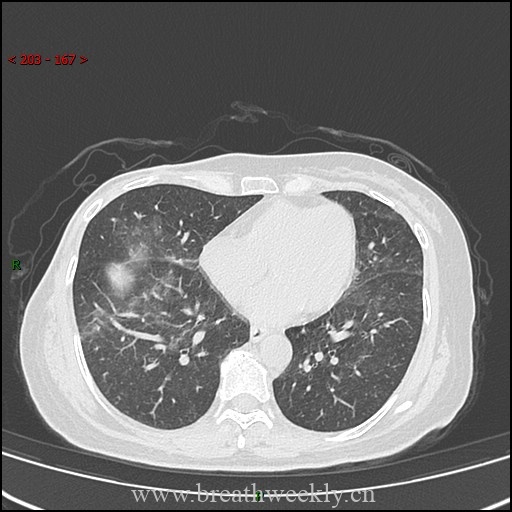 图片[12]-病例57 药物性肺损伤影像读片 | 每周呼吸-每周呼吸