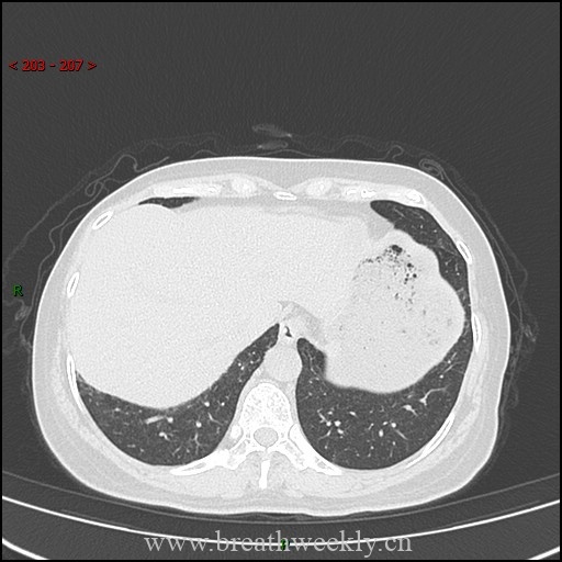 图片[14]-病例57 药物性肺损伤影像读片 | 每周呼吸-每周呼吸