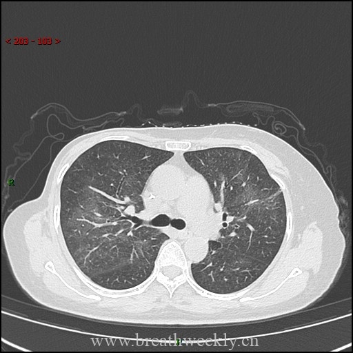 图片[8]-病例57 药物性肺损伤影像读片 | 每周呼吸-每周呼吸