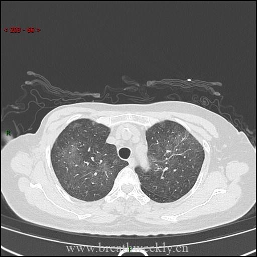 图片[4]-病例57 药物性肺损伤影像读片 | 每周呼吸-每周呼吸