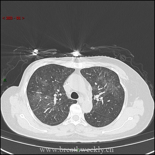 图片[6]-病例57 药物性肺损伤影像读片 | 每周呼吸-每周呼吸