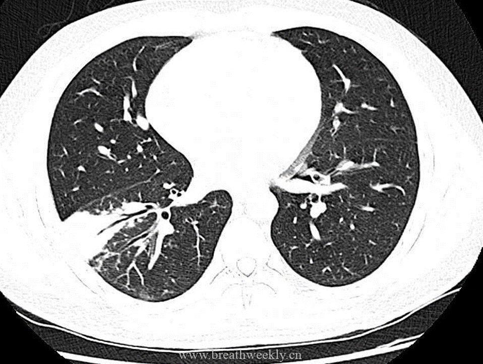 病例54 支原体肺炎 每周呼吸-每周呼吸