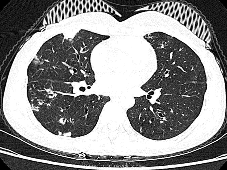 图片[1]-病例53 肺结核的影像特点 | 每周呼吸-每周呼吸