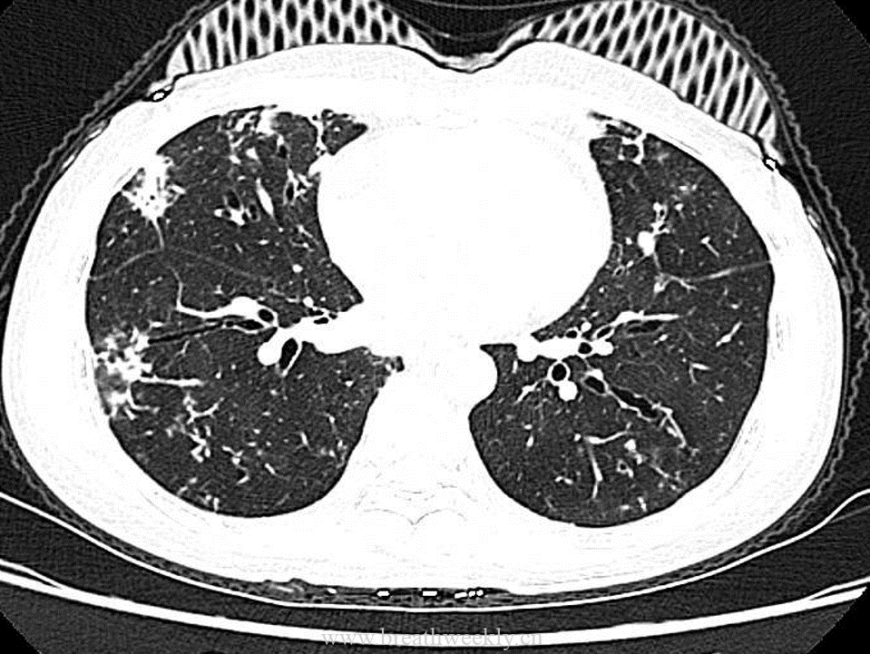 图片[2]-病例53 肺结核的影像特点 | 每周呼吸-每周呼吸