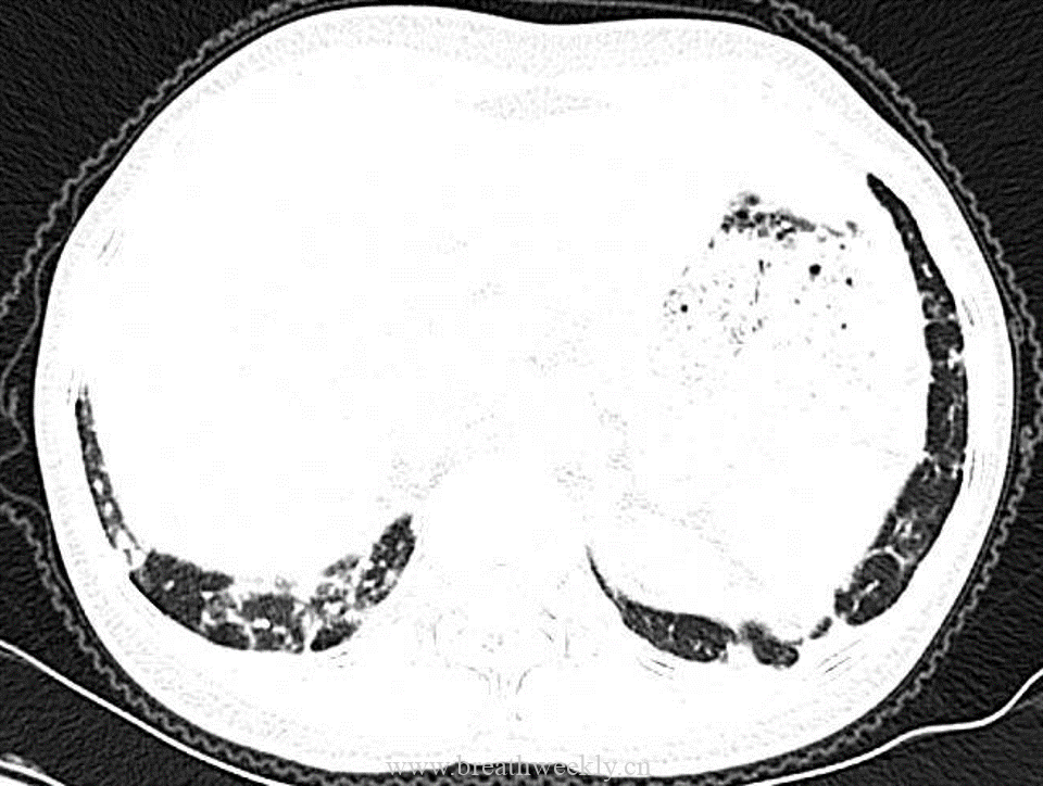 图片[7]-病例53 肺结核的影像特点 | 每周呼吸-每周呼吸