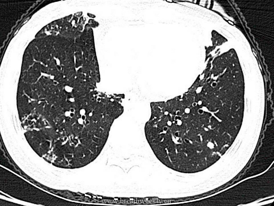病例53 肺结核的影像特点 | 每周呼吸-每周呼吸