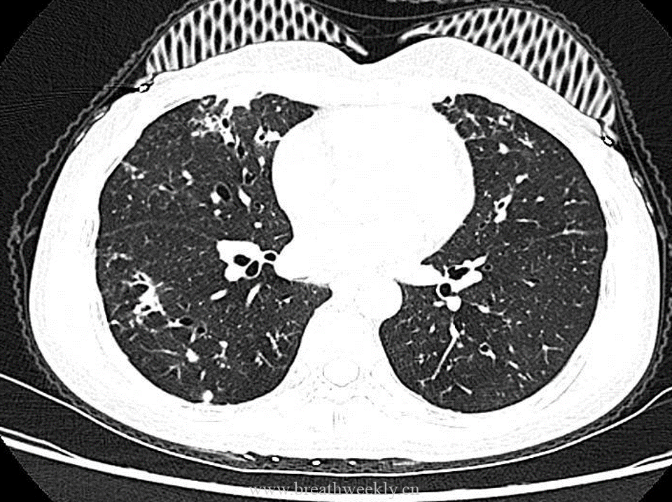 图片[3]-病例53 肺结核的影像特点 | 每周呼吸-每周呼吸