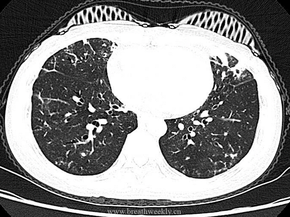 图片[4]-病例53 肺结核的影像特点 | 每周呼吸-每周呼吸