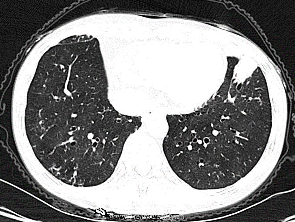 图片[5]-病例53 肺结核的影像特点 | 每周呼吸-每周呼吸