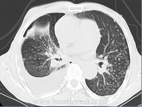 图片[10]-病例52| 每周呼吸-每周呼吸