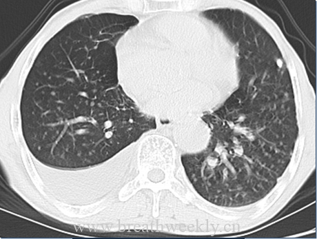 图片[11]-病例52| 每周呼吸-每周呼吸