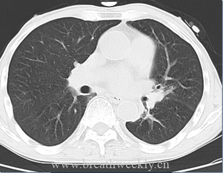图片[4]-病例51 | 每周呼吸-每周呼吸