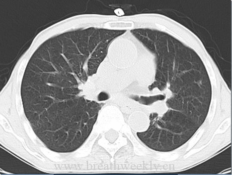 图片[3]-病例51 | 每周呼吸-每周呼吸