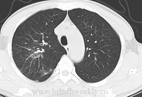 图片[7]-病例50 | 每周呼吸-每周呼吸