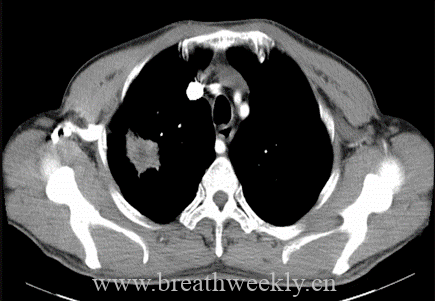 图片[15]-病例50 | 每周呼吸-每周呼吸