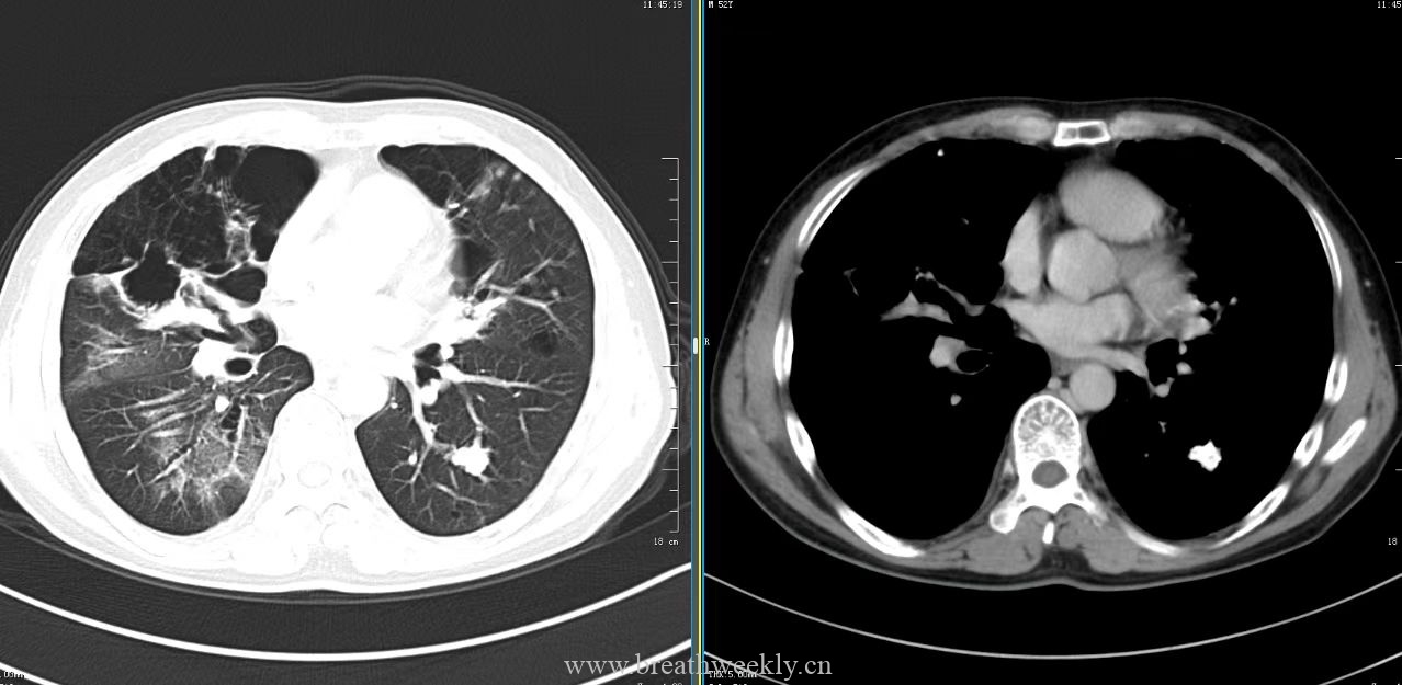 图片[10]-病例49 | 每周呼吸-每周呼吸