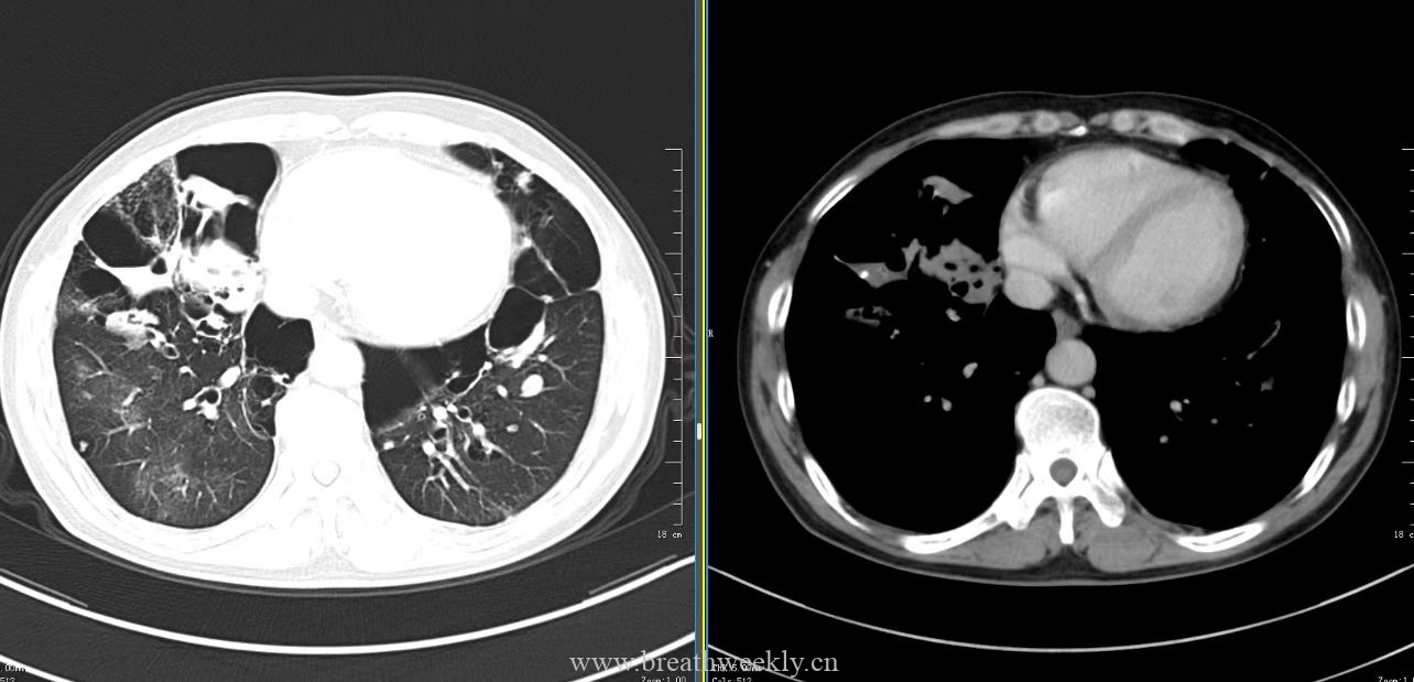 图片[6]-病例49 | 每周呼吸-每周呼吸
