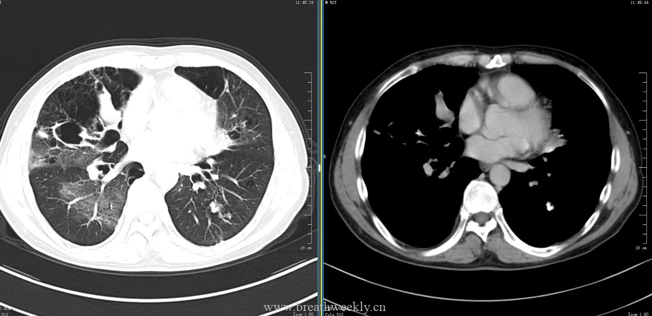 图片[3]-病例49 | 每周呼吸-每周呼吸