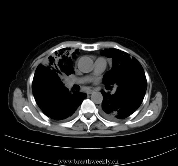 图片[7]-病例48 | 每周呼吸-每周呼吸