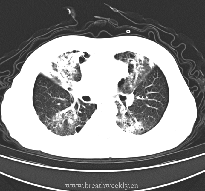 图片[5]-病例48 | 每周呼吸-每周呼吸