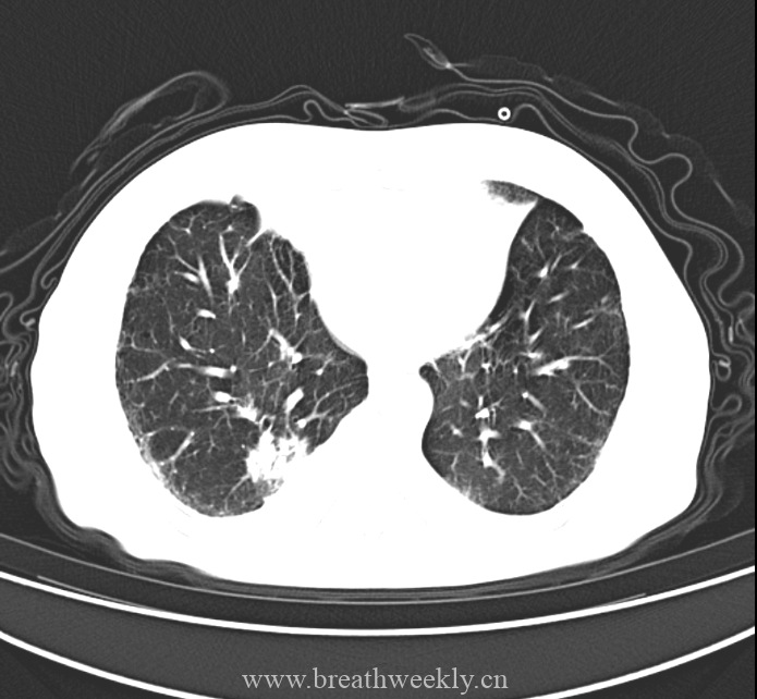 图片[6]-病例48 | 每周呼吸-每周呼吸