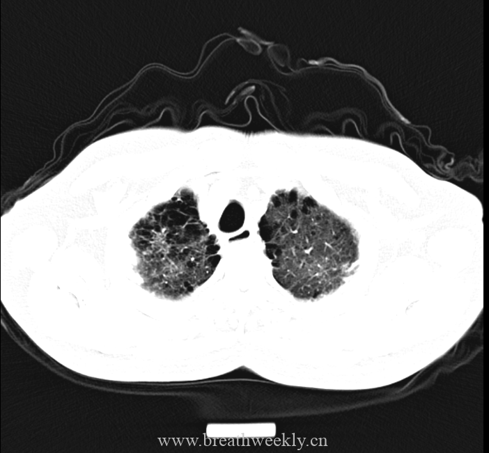 图片[1]-病例48结果 | 每周呼吸-每周呼吸