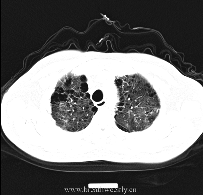 图片[2]-病例48结果 | 每周呼吸-每周呼吸