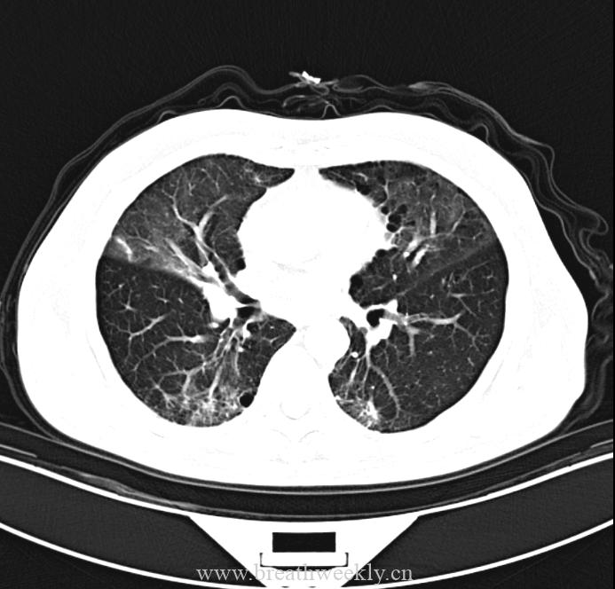 图片[4]-病例48结果 | 每周呼吸-每周呼吸