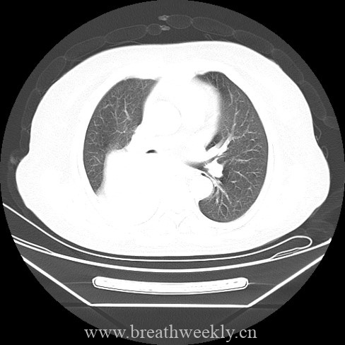 图片[3]-病例46 | 每周呼吸-每周呼吸