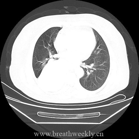 图片[4]-病例46 | 每周呼吸-每周呼吸