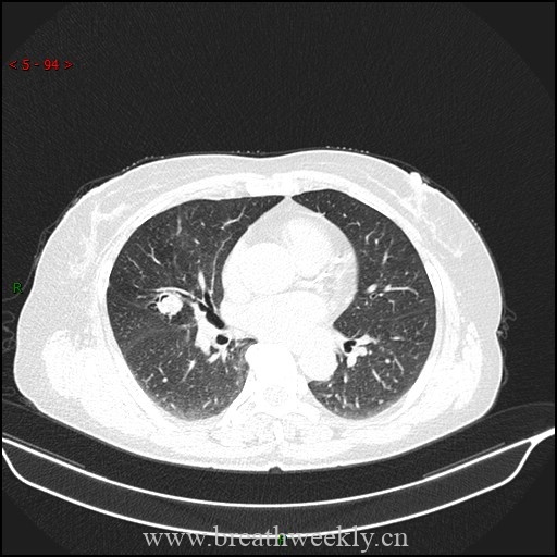 肺曲霉病的典型影像表现 | 每周呼吸-每周呼吸