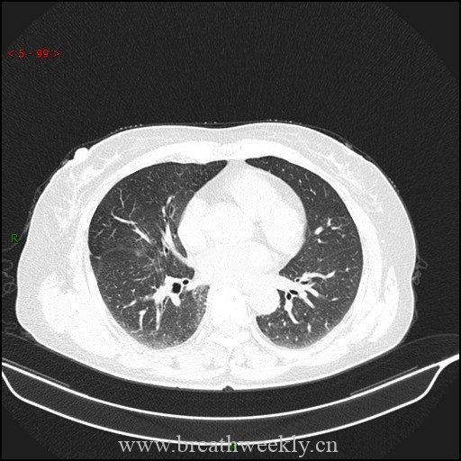 化疗药物性肺损伤CT表现（DICOM格式） | 每周呼吸-每周呼吸