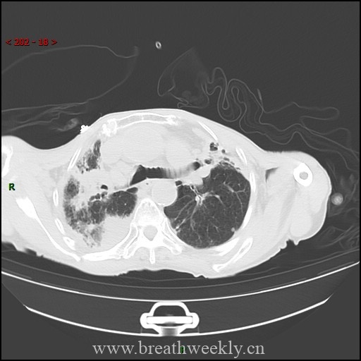 图片[1]-病例62 | 每周呼吸-每周呼吸