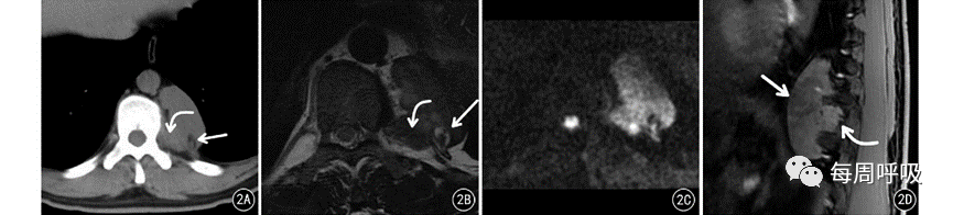 图片[25]-胸部神经源性肿瘤的分类及其影像学表现 | 每周呼吸-每周呼吸