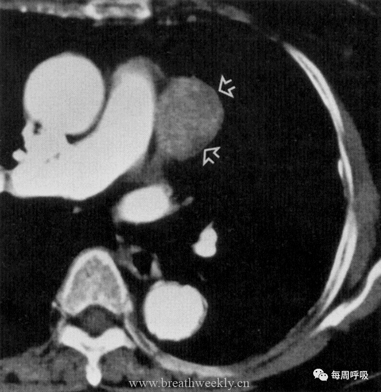 图片[29]-胸部神经源性肿瘤的分类及其影像学表现 | 每周呼吸-每周呼吸