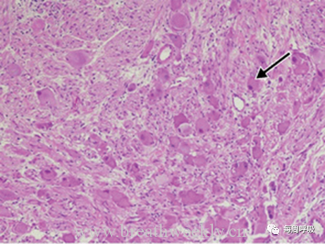 图片[9]-胸部神经源性肿瘤的分类及其影像学表现 | 每周呼吸-每周呼吸