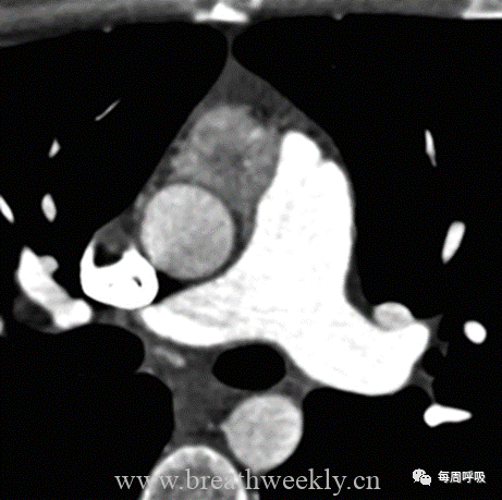 图片[13]-胸部神经源性肿瘤的分类及其影像学表现 | 每周呼吸-每周呼吸