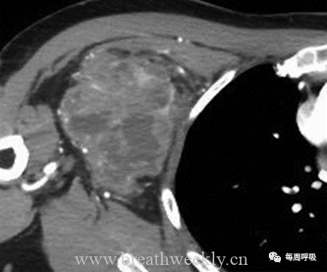 图片[20]-胸部神经源性肿瘤的分类及其影像学表现 | 每周呼吸-每周呼吸