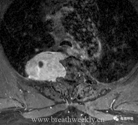 图片[16]-胸部神经源性肿瘤的分类及其影像学表现 | 每周呼吸-每周呼吸