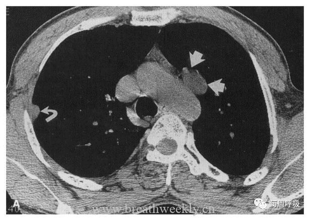 图片[31]-胸部神经源性肿瘤的分类及其影像学表现 | 每周呼吸-每周呼吸