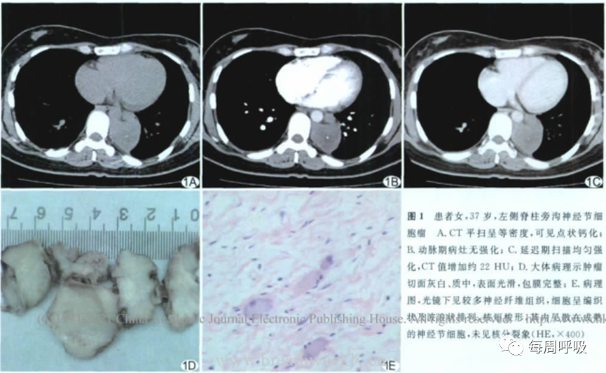 图片[26]-胸部神经源性肿瘤的分类及其影像学表现 | 每周呼吸-每周呼吸