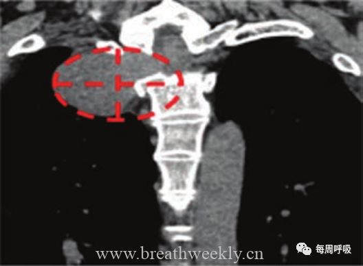 图片[6]-胸部神经源性肿瘤的分类及其影像学表现 | 每周呼吸-每周呼吸