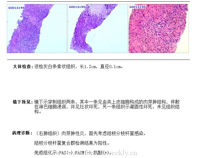 病例56结果 | 每周呼吸-每周呼吸