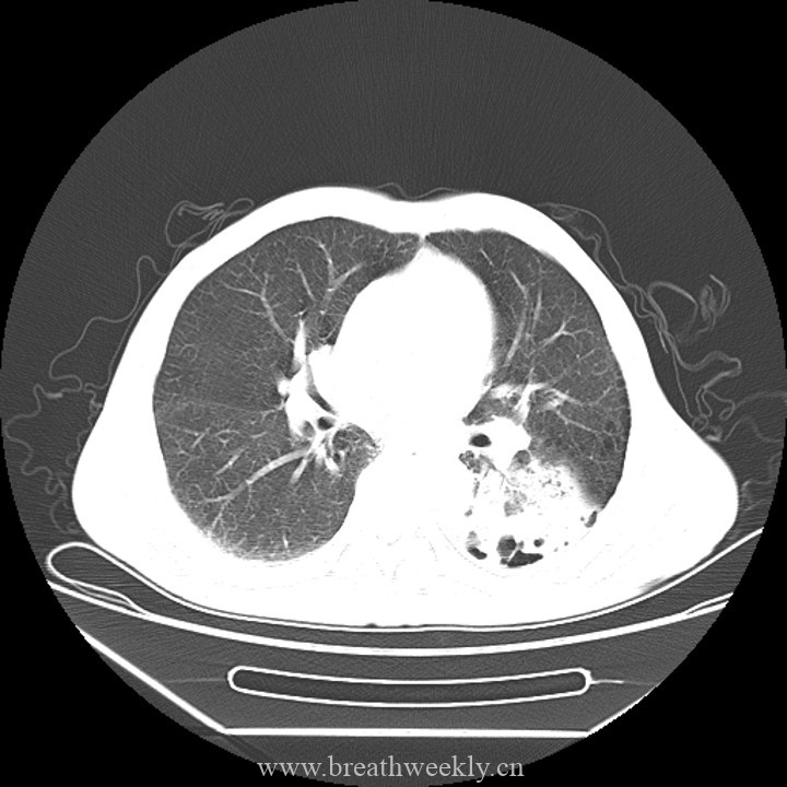 图片[1]-病例45 | 每周呼吸-每周呼吸