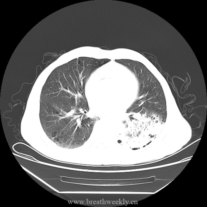 病例45 | 每周呼吸-每周呼吸