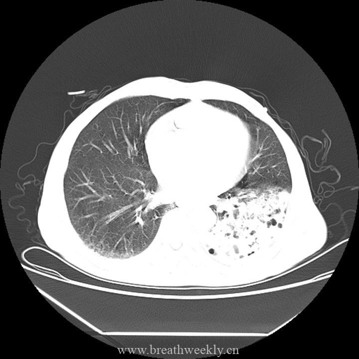 图片[3]-病例45 | 每周呼吸-每周呼吸